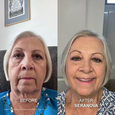 Lower Face Sagging