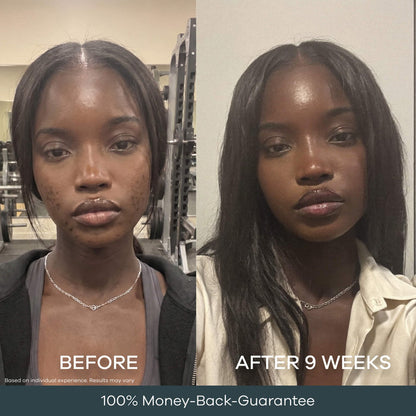 The Micro Infusion System™ For Melanin-Rich Skin