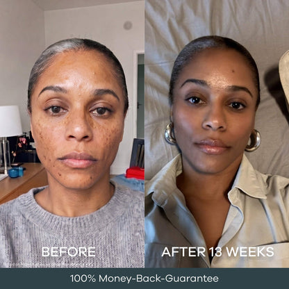 The Micro Infusion System™ For Melanin-Rich Skin