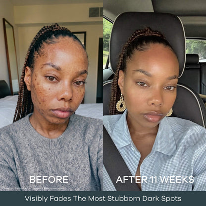 The Micro Infusion System™ For Melanin-Rich Skin