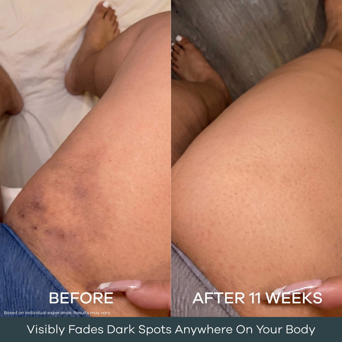 The Micro Infusion System™ For Melanin-Rich Skin