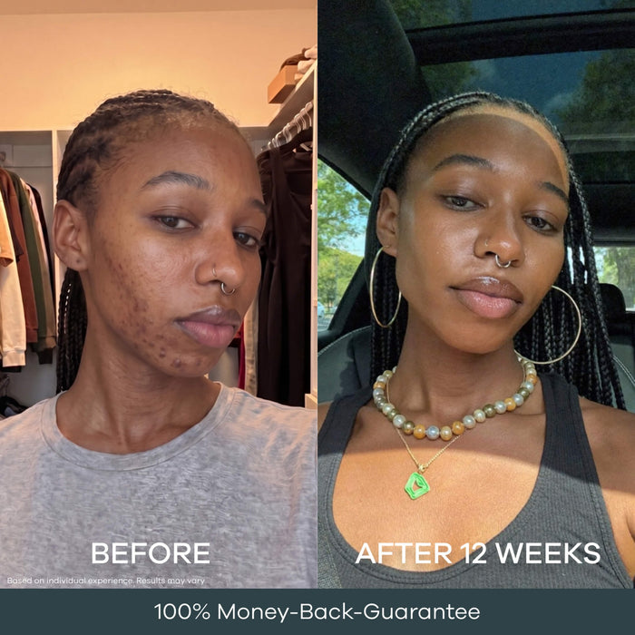 The Micro Infusion System™ For Melanin-Rich Skin