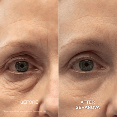 Under Eye Wrinkles